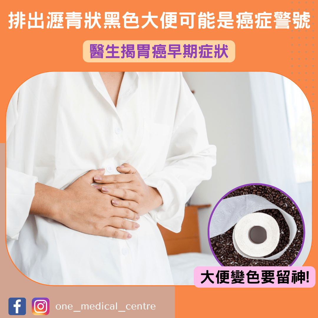 【排出瀝青狀黑色大便可能是癌症警號　醫生揭胃癌早期症狀】